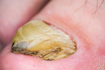 Fototapeta premium Macro photo of a human toenail with fungus