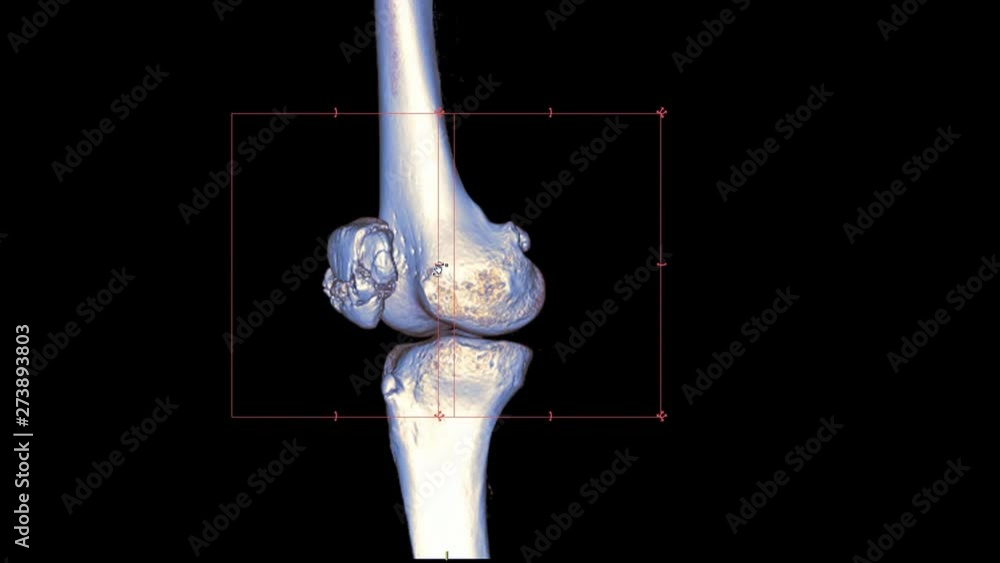 Poster ct knee or ct scan image of right knee 3d rendering image rotating on monitor showing fracture patel