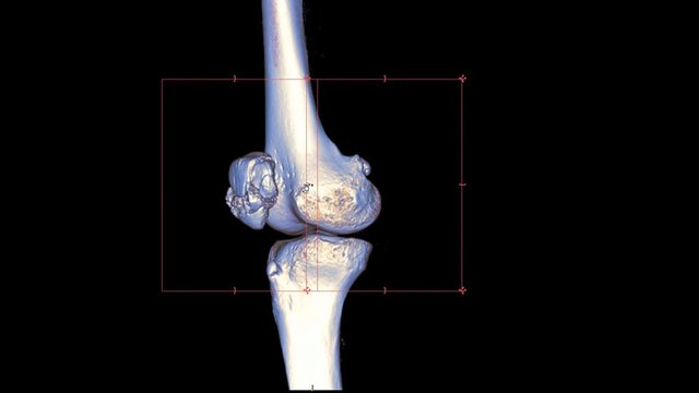 CT Knee or CT Scan image of Right knee  3d rendering image rotating on monitor showing fracture patella.