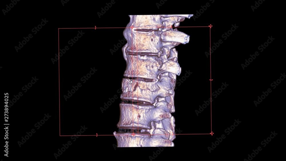 Poster ct scan of t-l spine or thoracolumbar junction spine 3d rendering image turn around on the screen sh