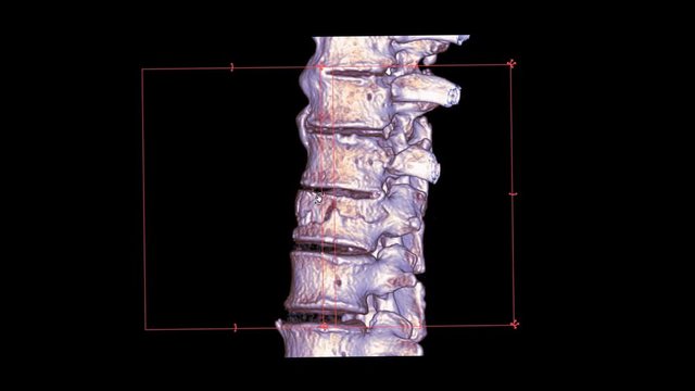 CT Scan of T-L spine or thoracolumbar junction spine 3D rendering image turn around on the screen showing fracture L1 spine.