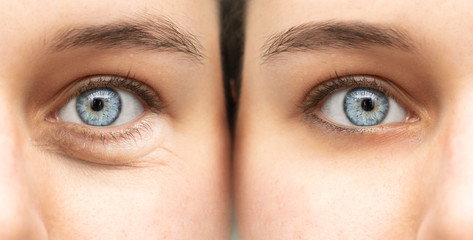 Before and after view of blepharoplasty surgery, plastic surgery of the eyes to remove puffy bags, a common symptom of sleep deprivation and stress.