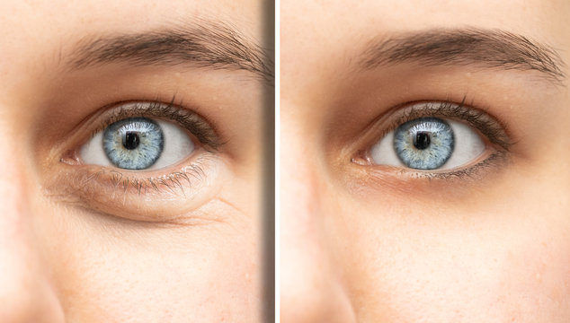 A split screen view on the blue eyes of a beautiful young Caucasian woman, the left image shows a swollen eye bag caused by fluid retention, the right image shows the result of oculoplastic surgery.