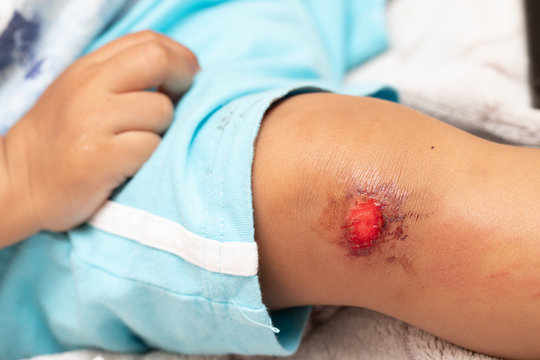 The leg of a young boy is seen closeup shortly after an injury, blood stained shorts sit above a badly grazed and bleeding knee with bruising to the shin. Copy space to the lower left.