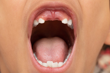 A closeup and front view on the mouth of young boy, he opens jaws wide to reveal two missing front...