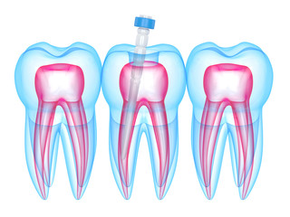 3d render of teeth with fiber post over white