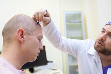 Baldness treatment. Patient suffering from hair loss in consultation with a doctor. Preparation for...