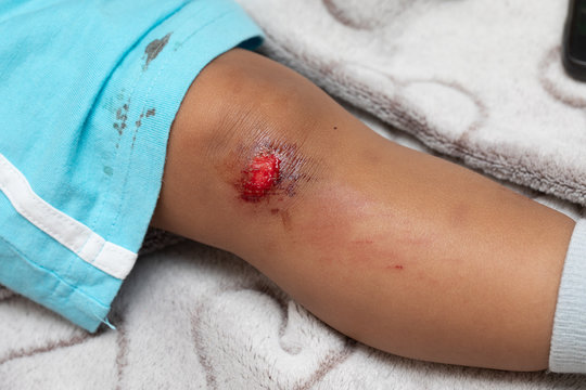 A closeup view on the leg of a youngster wearing shorts, his kneecap is grazed and bloody. Under 5 years old boy with abrasion to knee, copy space on the left.