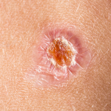 A closeup view of a small skin wound during the healing process, yellow and scabby showing signs of a minor infection, details of new skin scabbed lesion.