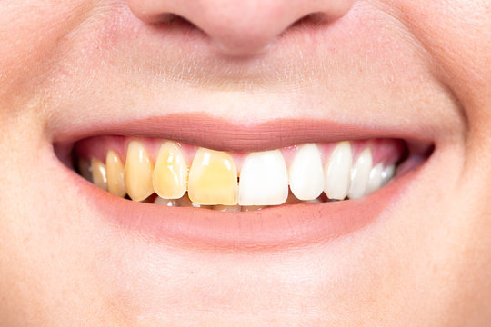 A closeup and front shot on the mouth of a Caucasian person, before and after view of tooth whitening. Cosmetic dentistry concept.