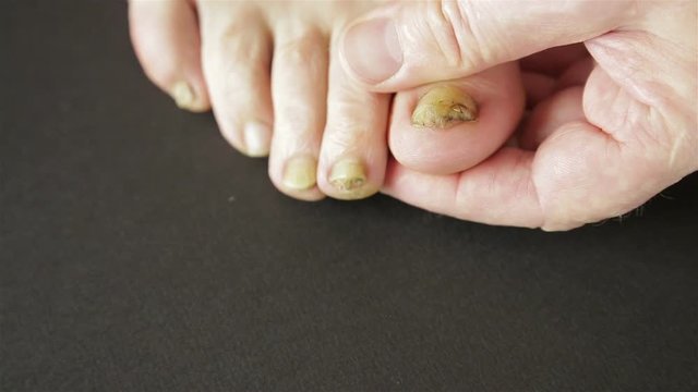 Infectious fungus on the nails of the toes of a man