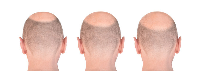 Hair loss process step by step. Back view of balding male head isolated on white background. Detail showed alopecia