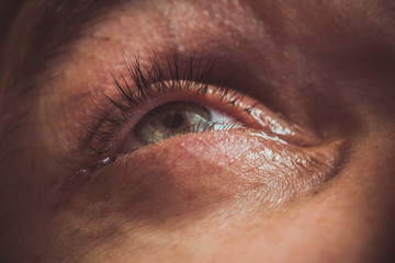 a man drips open human eye with bright red arteries drops to improve vision close up. irritation...