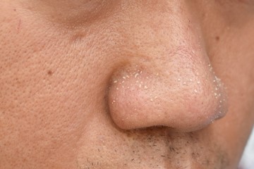 acne vulgaris on nose of asian man