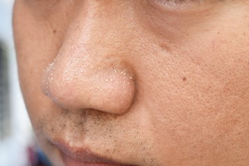 acne vulgaris on nose of asian man