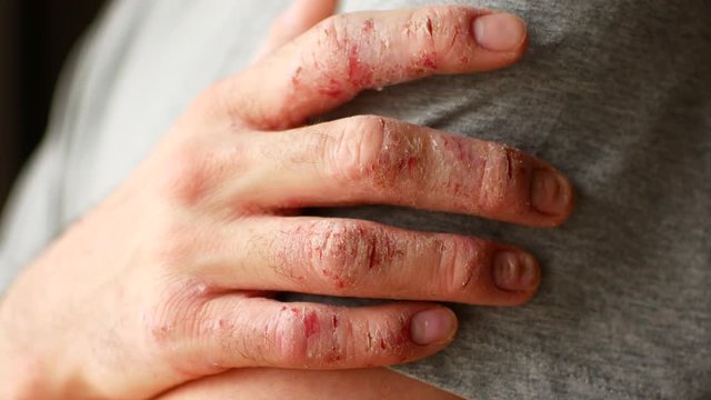 Fingers of a man with psoriasis and eczema. A close-up of the skin peeling