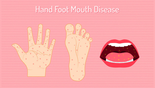 Hand Foot Mouth Disease. Enteroviruses Or EV71 Is Name Of Virus. Be Careful Of Your Chidren And Yourself. Beautiful Color Background. Vector Illustration Eps10