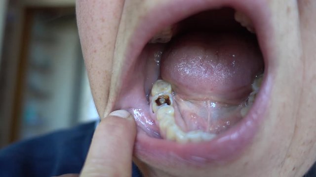 4K Seeing into a decayed tooth in female mouth