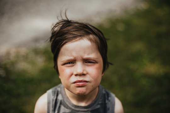 An Unhappy Boy Has A Bug Bite On His Eye