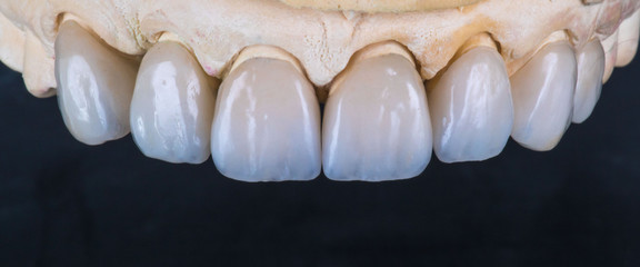 dental veneers and crowns