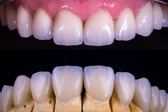 dental veneers and crowns