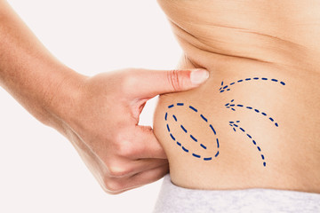 Liposuction plastic surgery marks lines on woman body for fat reduction around waist. Slim women...