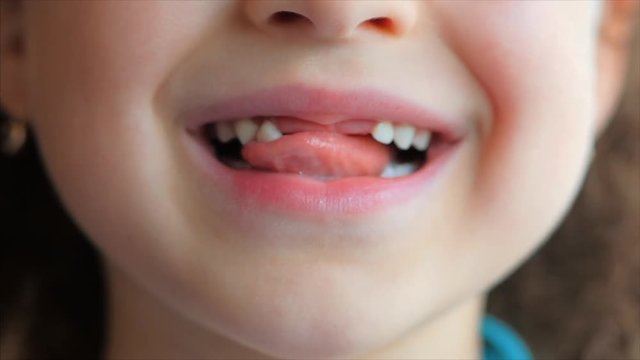 Close-up of a Little Girl's smile, Baby Teeth. Child Shakes His Tongue Milk Tooth.