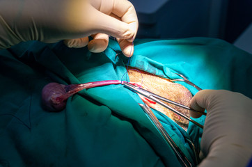 Ligation of the vas deferens and its vessels