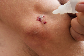 bleeding wound, skin damage, blood on the skin, wound treatment with hydrogen peroxide