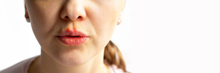 Part of a young woman face with red bubbles of virus herpes on lips Medicine, treatment. Long horizontal banner with copy space Selective focus Close up