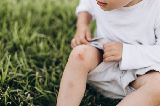 photo of a little girl who fell and scratched his knee in the blood, it hurts the wound and it keeps a handle on the leg, but not crying