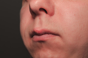 Second day of growing herpes on caucasian male man on front upper lip