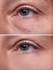 Fototapeta premium Eye Bags Before And After Cosmetic Treatment