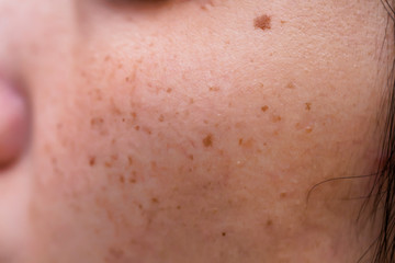 Woman 's problematic skin , acne scars ,oily skin and pore, dark spots and blackhead and whitehead...