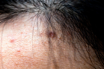 Woman 's problematic skin , acne scars ,oily skin and pore, dark spots and blackhead and whitehead...