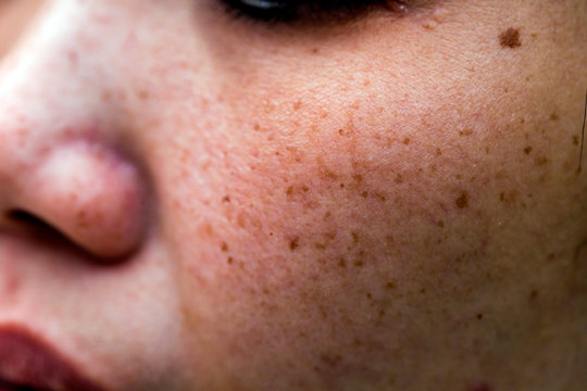 Woman 's problematic skin , acne scars ,oily skin and pore, dark spots and blackhead and whitehead on the face