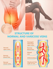 Varicose veins on a female senior legs. The structure of normal and varicose veins.