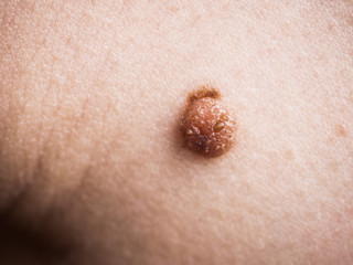 Fototapeta premium Unrecognizable person having dark fibroma, dermatology problem on skin. Close up of papilloma dermatosis