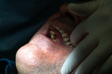 Professional dentist surgeon installing a dental implant