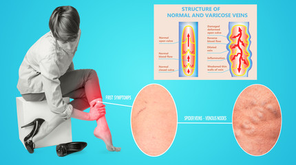 Varicose veins on a female senior legs. The structure of normal and varicose veins.