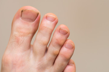 Male foot with symptoms of fungal nail plate. Nails on man's legs. Caucasian foot with dirty and nails