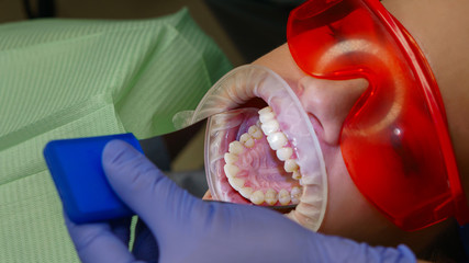 Dentist examines the condition of the teeth of the upper jaw of the girl patient. Examination by a dentist. Dental clinic. Health care. © Vagengeim
