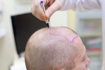 Baldness treatment. Patient suffering from hair loss in consultation with a doctor. Preparation for...