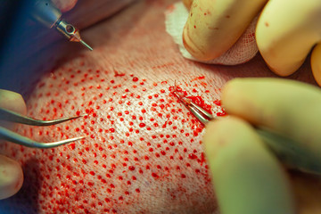 Patient's head close-up. Baldness treatment. Hair transplant. Surgeons in the operating room carry...