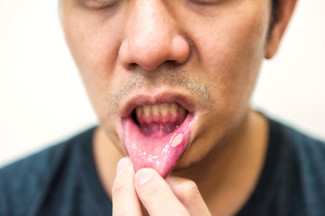 Pained aphtha ulcer mouth from accident