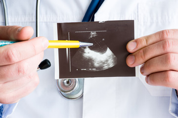 Pancreas cyst on ultrasound image concept photo. Doctor indicating by pen on printed picture...