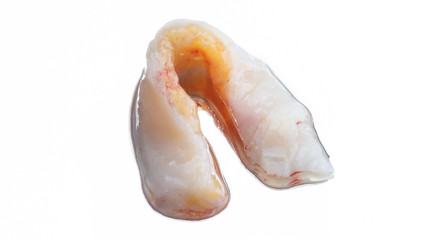 beautiful photo of soft tissue flap to restore gums, shot on a white background