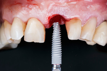 high-quality dental implant on the background of the patient's mouth before implantation
