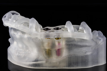pattern on a model printed in a 3D printer with implants and abutments on a black background
