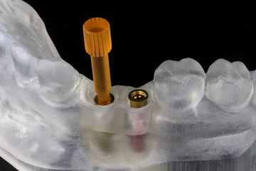 Dental polymer model with base abutments on a black background